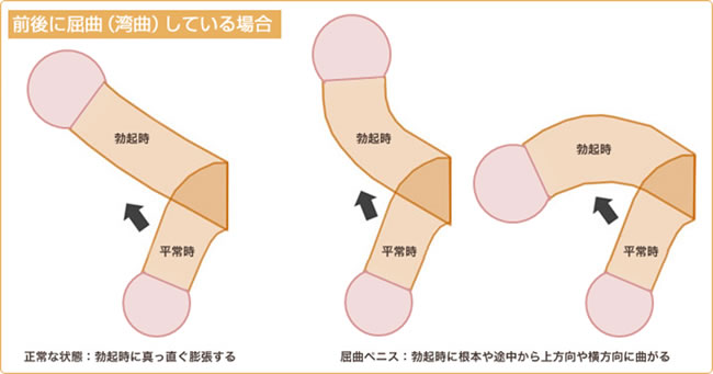 屈曲・湾曲ペニスのイメージイラスト1
