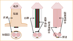屈曲・湾曲ペニス修正手術について