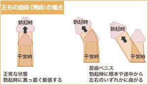 左右の屈曲・湾曲