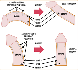 屈曲・湾曲ペニス修正手術について
