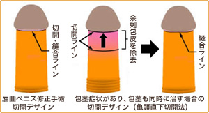 屈曲・湾曲ペニス修正手術について